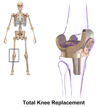 knee_replacement