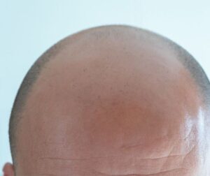 top of a bald man's head